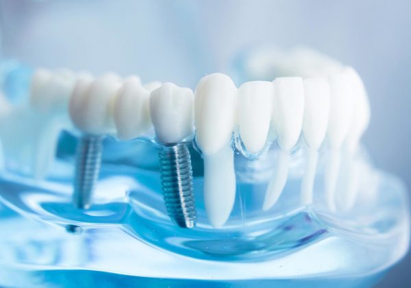 dental-implant-treatment-1