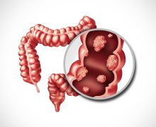 digestive-health-colon-cancer-prevention